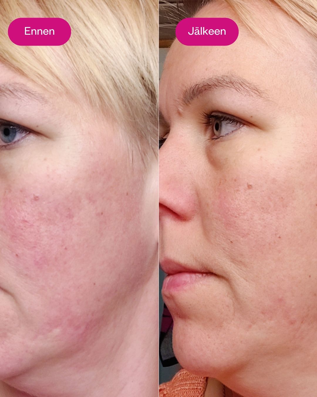 AHA & BHA PEELING SERUM kuoriva ja kirkastava yöseerumi 30 ml
